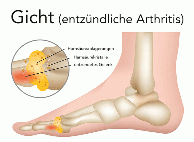 Gicht (entzündliche Arthritis)