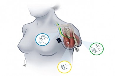 Das hier dargestellte System erlaubt erstmalig die bidirektionale Übertragung von Biosignalen in eine prothetische Hand - ©MedUni Wien/A. Cserveny