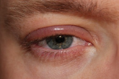 Blepharitis - ©Wikipedia_Gemeinfrei_clubtable - Selbst fotografiert