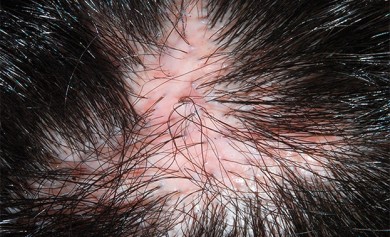 Haartransplantation - ©Micha L. Rieser, wikimedia.org