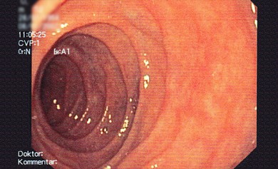 Darmspiegelung ©gesundheit.com